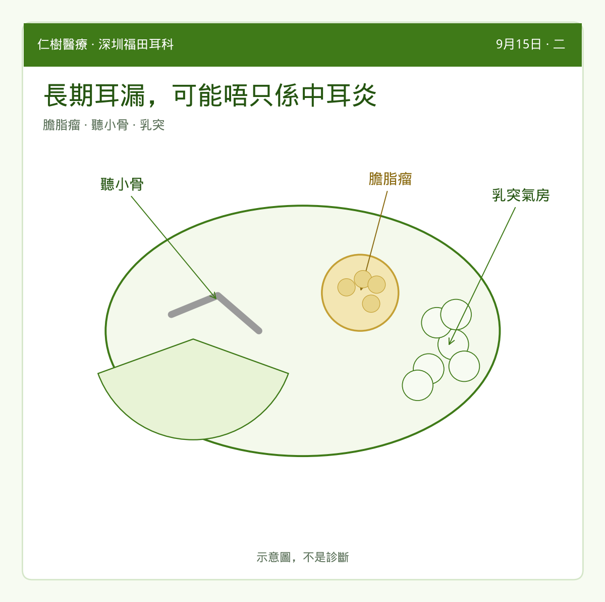 示意：膽脂瘤、聽小骨與乳突氣房