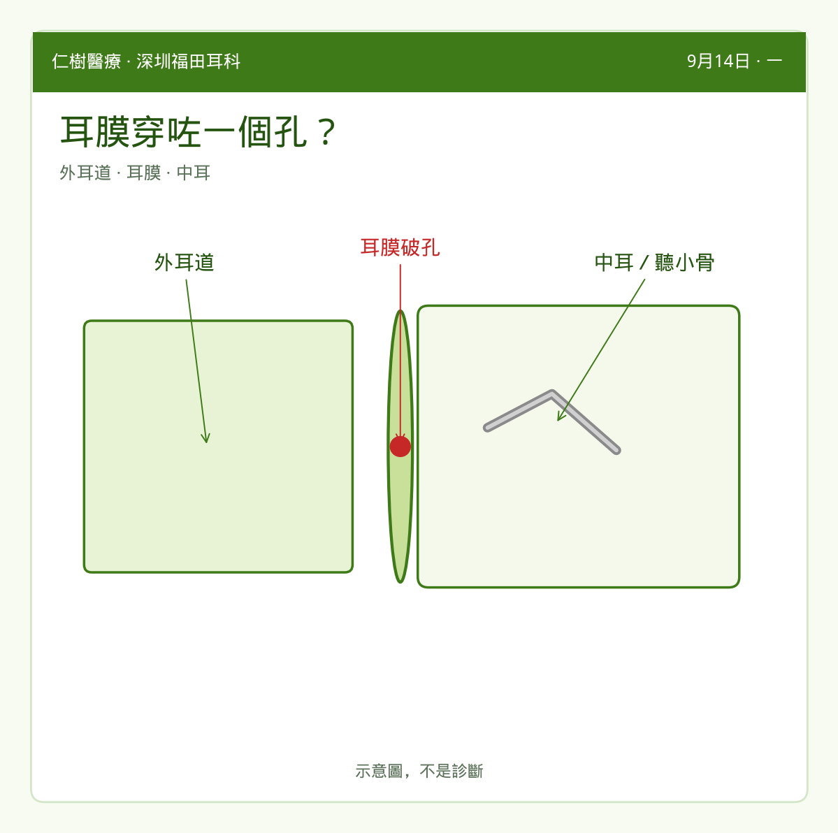 示意：外耳道、耳膜破孔與中耳聽小骨