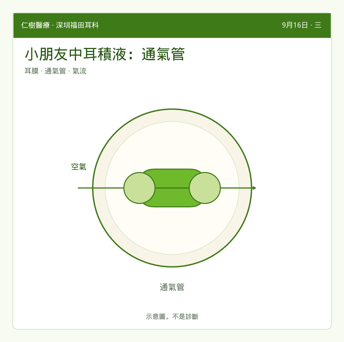 示意：通氣管穿過耳膜幫助空氣流通
