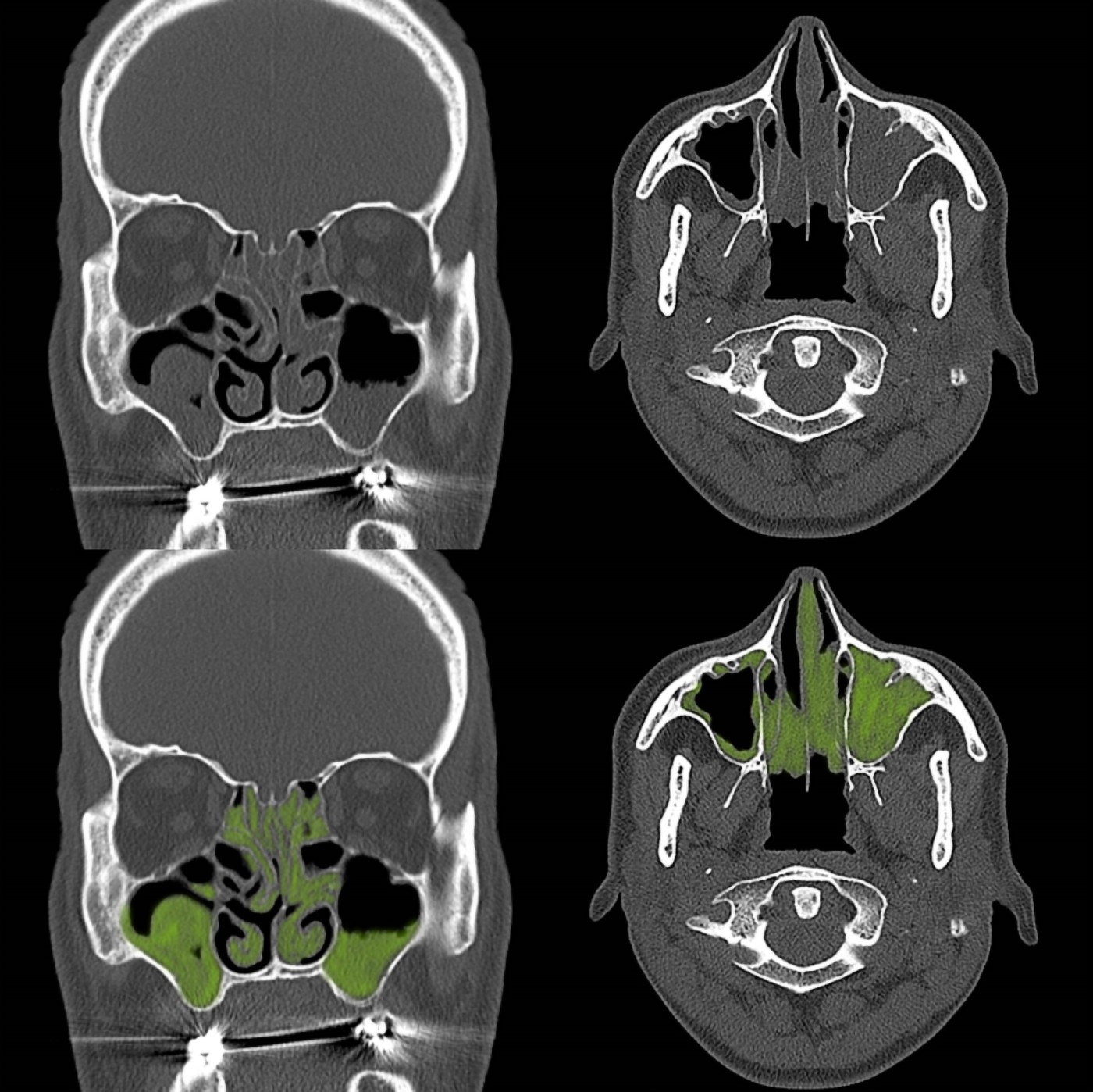 鼻竇 CT 影像